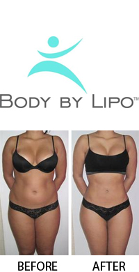 Body By Lipo