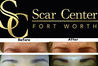 Scar Center Fort Worth