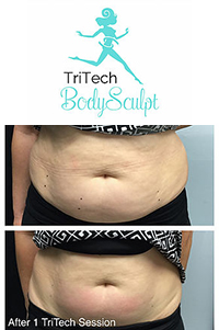 TriTech Body Sculpt